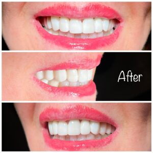 Teeth Whitening Procedures near Spring