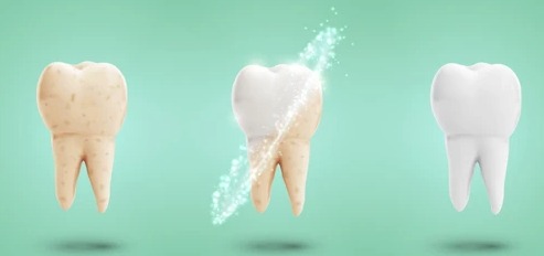 The Magic of Teeth Whitening