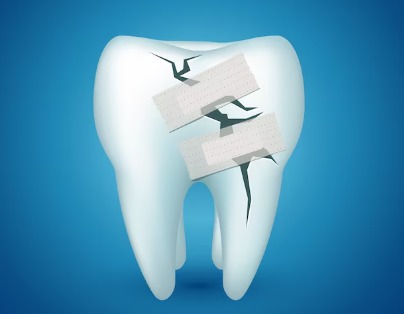 Causes of Broken Teeth
