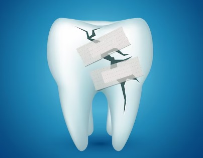 Broken Tooth Treatment In Spring TX 77379
