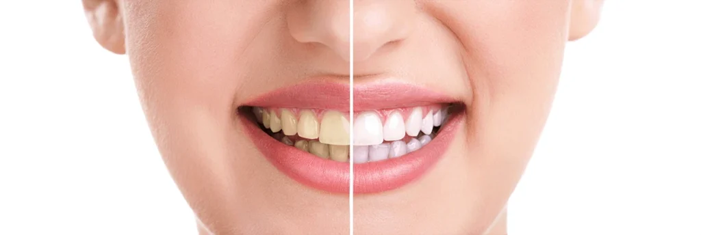 Teeth Whitening near Spring 77379